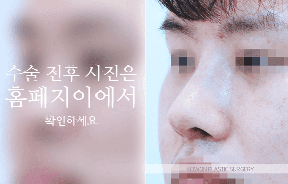 การผ่าตัดปลายจมูกกลมใหญ่ในผู้ชาย: เหตุใดจึงต้องพิจารณาส่วนนูนและปีกจมูกไปพร้อมกัน — ภาพประกอบที่เกี่ยวข้องกับความสมดุลของปลายจมูก สันจมูกและปีกจมูก 6/10