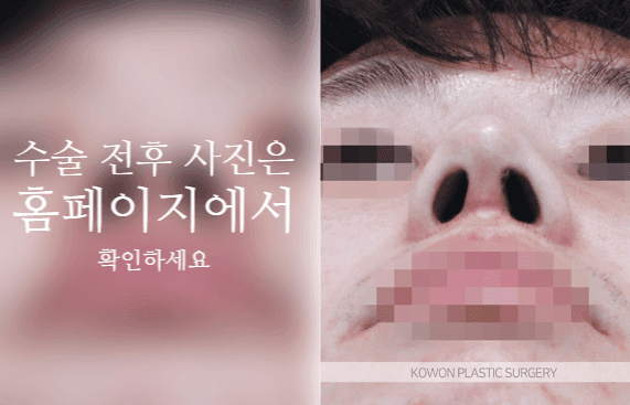 การผ่าตัดปลายจมูกกลมใหญ่ในผู้ชาย: เหตุใดจึงต้องพิจารณาส่วนนูนและปีกจมูกร่วมกัน — ภาพประกอบที่เกี่ยวข้องกับความสมดุลของปลายจมูก สันจมูกและปีกจมูก 7/10