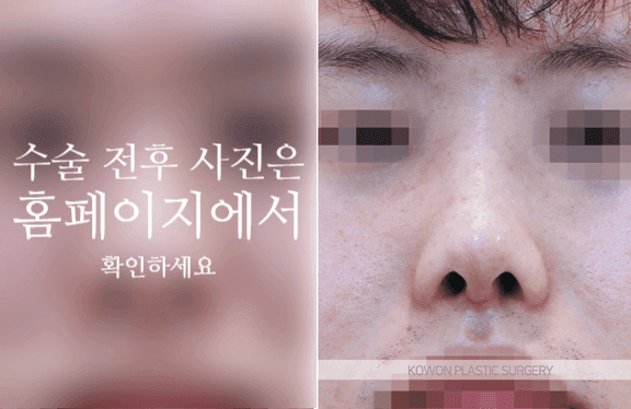 남자 복코수술, 매부리와 콧볼을 함께 봐야 하는 이유 — 코끝·콧대·콧볼의 균형 관련 이미지 8/10