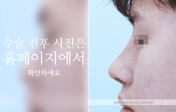 การผ่าตัดปลายจมูกกลมใหญ่ในผู้ชาย: เหตุใดจึงต้องพิจารณาส่วนนูนและปีกจมูกร่วมกัน — ภาพที่ 9/10 เกี่ยวข้องกับความสมดุลของปลายจมูก สันจมูกและปีกจมูก