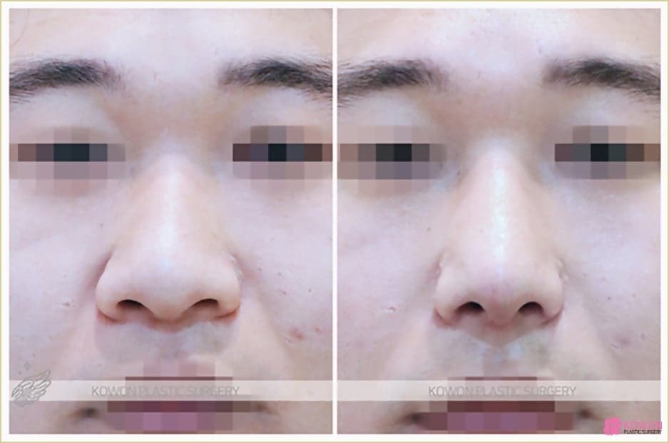 남자 복코, 코끝만 세우면 될까 — 구조 판단과 병원 선택의 네 가지 기준 관련 이미지 7/8