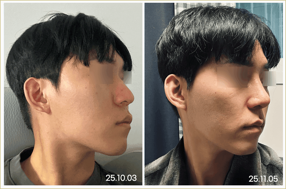 남자 복코, 코끝만 세우면 될까 — 구조 판단과 병원 선택의 네 가지 기준 관련 이미지 8/8