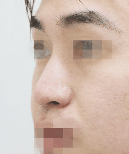 남자 매부리코 수술, 콧대와 코끝을 함께 보는 이유 — 튀어나온 부분만 다듬으면 되나요? 관련 이미지 4/7