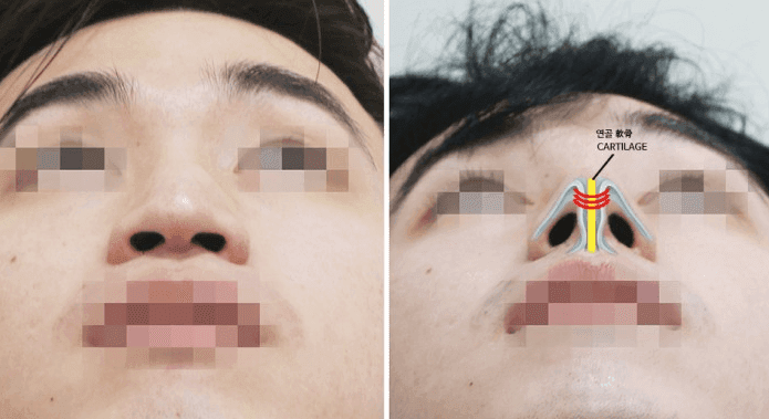 남자 매부리코 수술, 콧대와 코끝을 함께 보는 이유 — 튀어나온 부분만 다듬으면 되나요? 관련 이미지 5/7