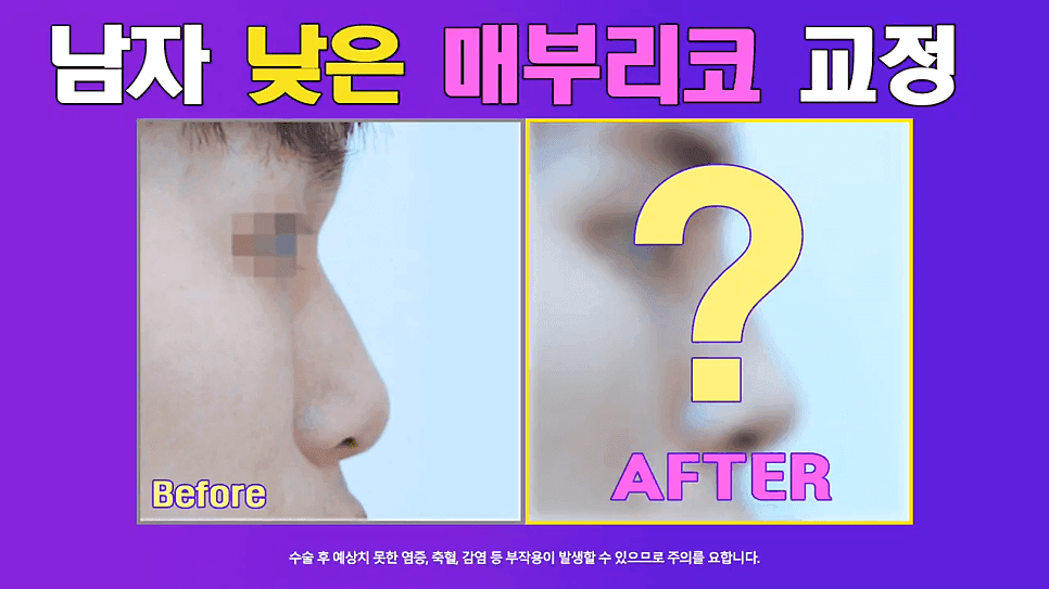 매부리교정과 코끝내림근제거를 함께 한 이유 — 낮은코 남성의 콧대 교정 사례 관련 이미지 1/8