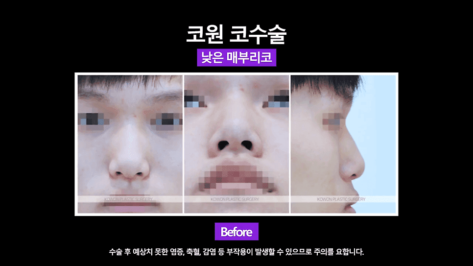 매부리교정과 코끝내림근제거를 함께 한 이유 — 낮은코 남성의 콧대 교정 사례 관련 이미지 4/8