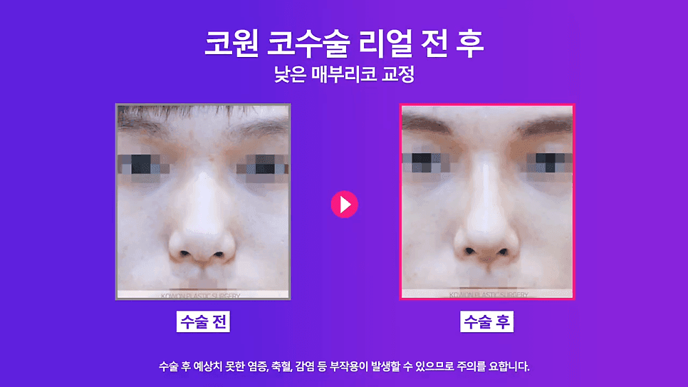 เหตุผลในการรวมการแก้ไขสันจมูกและการผ่าตัดกล้ามเนื้อกดปลายปลายจมูก— ภาพประกอบที่เกี่ยวข้องกับกรณีการแก้ไขสันจมูกในผู้ชายจมูกต่ำ 5/8