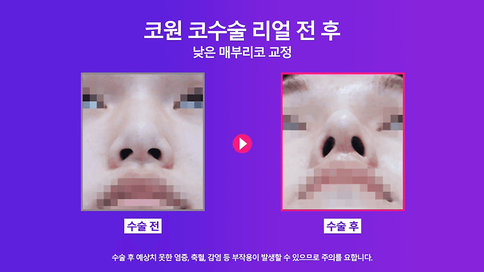 매부리교정과 코끝내림근제거를 함께 한 이유 — 낮은코 남성의 콧대 교정 사례 관련 이미지 6/8