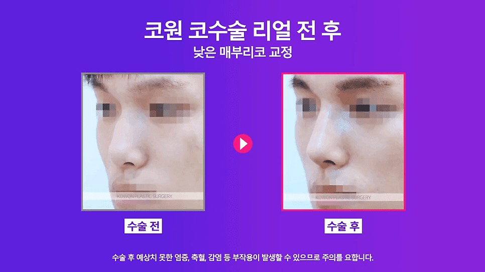 เหตุผลในการรวมการแก้ไขสันจมูกและการผ่าตัดกล้ามเนื้อกดปลายปลายจมูก— ภาพประกอบที่เกี่ยวข้องกับกรณีการแก้ไขสันจมูกในผู้ชายจมูกต่ำ 7/8