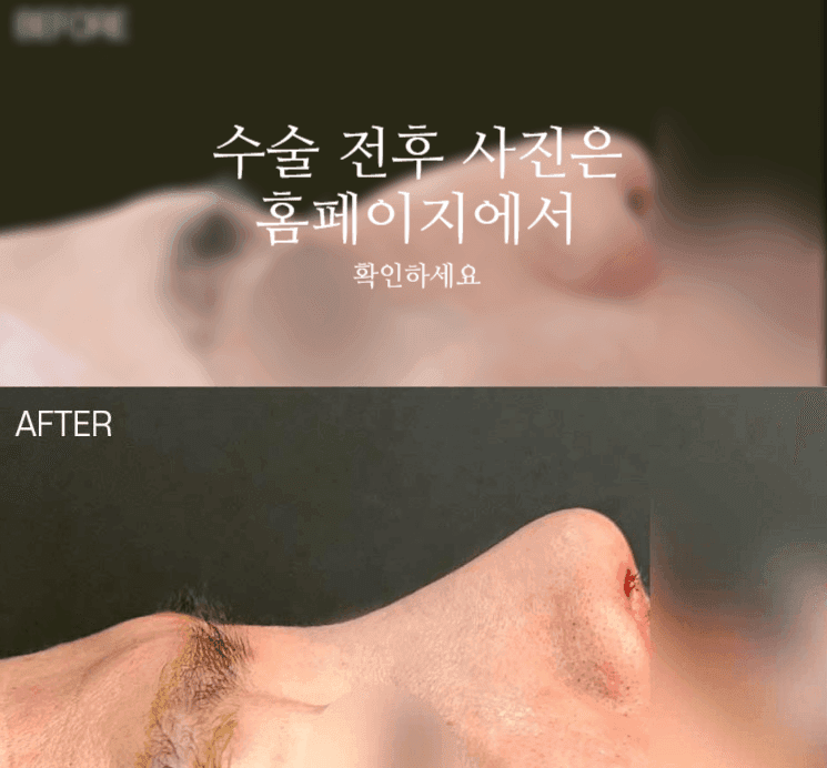 남자 매부리코 교정, 휜코와 코 중심선까지 함께 봐야 하는 이유 관련 이미지 2/9