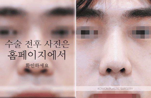 남자 매부리코 교정, 휜코와 코 중심선까지 함께 봐야 하는 이유 관련 이미지 5/9