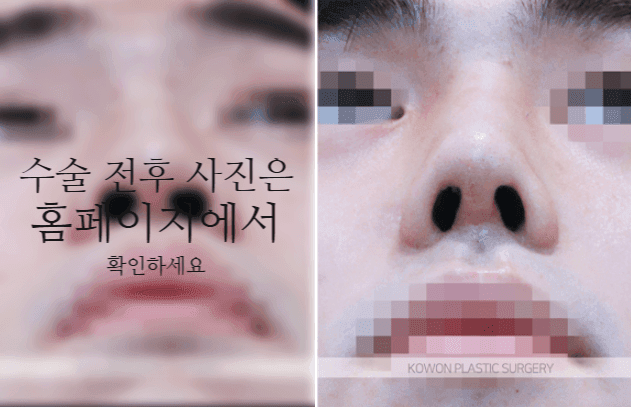 남자 매부리코 교정, 휜코와 코 중심선까지 함께 봐야 하는 이유 관련 이미지 7/9