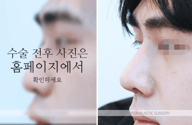 남자 매부리코 교정, 휜코와 코 중심선까지 함께 봐야 하는 이유 관련 이미지 8/9