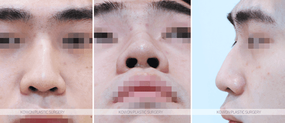 남자 매부리코수술, 실리콘 없이 자연스럽게 가능할까 — 외상 후 생긴 매부리의 교정 방향 관련 이미지 3/8
