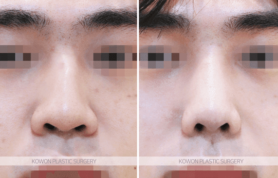 남자 매부리코수술, 실리콘 없이 자연스럽게 가능할까 — 외상 후 생긴 매부리의 교정 방향 관련 이미지 4/8