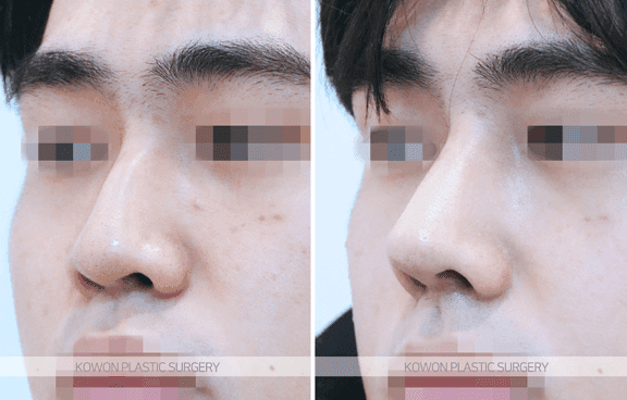 남자 매부리코수술, 실리콘 없이 자연스럽게 가능할까 — 외상 후 생긴 매부리의 교정 방향 관련 이미지 5/8