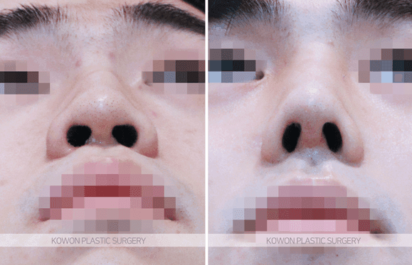 남자 매부리코수술, 실리콘 없이 자연스럽게 가능할까 — 외상 후 생긴 매부리의 교정 방향 관련 이미지 6/8