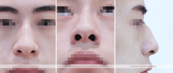 การผ่าตัดจมูกโหนกชาย จะทำให้รูปร่างเปลี่ยนไปอย่างไร? — ภาพประกอบเกี่ยวกับการเปลี่ยนแปลงก่อนและหลังผ่าตัด และระยะเวลาพักฟื้น 4/8