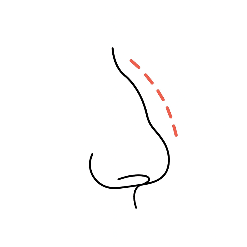 남자 매부리코, 자가늑연골로 개선 방향을 잡는 기준 — 콧등만 깎으면 안 되는 이유 관련 이미지 2/4