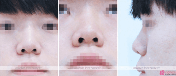 남자 매부리코수술, 병원마다 제안이 다를 때 — 비개방 절골과 개방형 수술의 선택 기준 관련 이미지 3/5