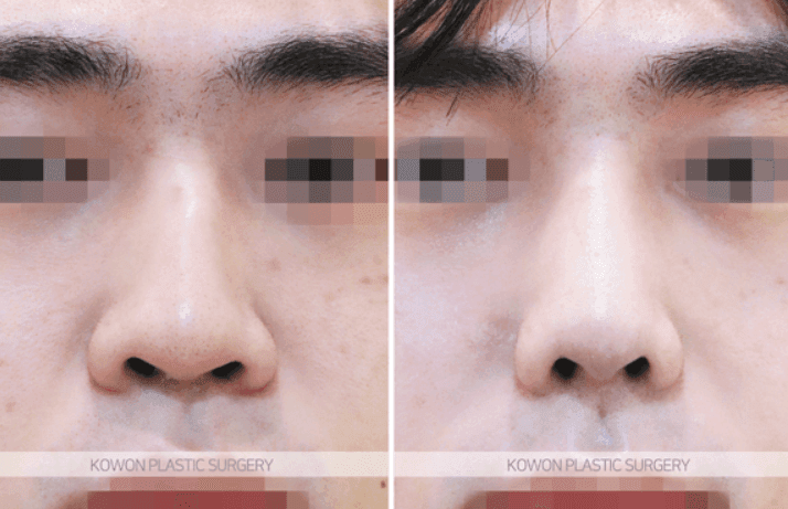 การแก้ไขจมูกโหนกก่อนและหลังศัลยกรรมจมูกชาย — ภาพที่เกี่ยวข้อง 5/9 ของกรณีที่ตรวจสอบทิศทางปลายจมูกด้วย ไม่ใช่แค่สันจมูกเท่านั้น