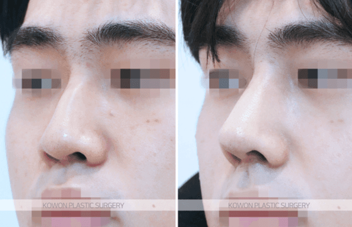 남자 코성형 전후로 보는 매부리코 교정 — 매부리만 정리하지 않고 코끝 방향까지 함께 본 사례 관련 이미지 6/9