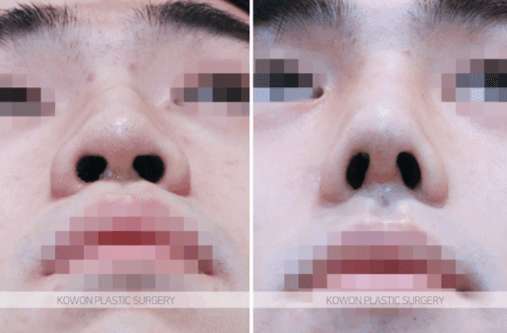남자 코성형 전후로 보는 매부리코 교정 — 매부리만 정리하지 않고 코끝 방향까지 함께 본 사례 관련 이미지 7/9