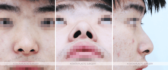Image 3/7 for: four questions on male rhinoplasty after septoplasty
