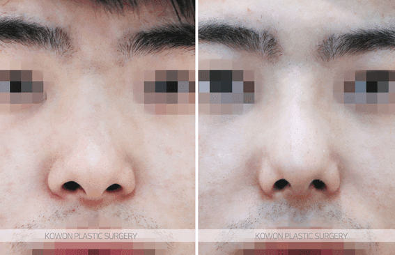 ปลายจมูกกลมใหญ่หลังการผ่าตัดผนังกั้นช่องจมูกคด· ข้อกังวลเกี่ยวกับศัลยกรรมจมูกในผู้ชาย — ตอบคำถามสี่ข้อที่เกี่ยวข้อง รูปภาพที่เกี่ยวข้อง 4/7