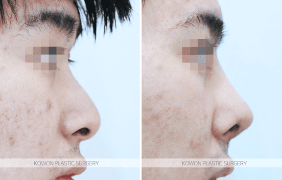비중격만곡증 수술 후 복코·남자코성형 고민 — 네 가지 질문에 답하다 관련 이미지 7/7