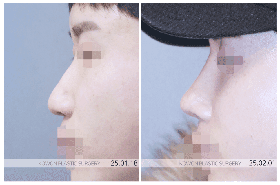 남자콧대수술, 어디부터 봐야 할까 — T존에서 시작하는 이유와 잘못 알려진 오해 관련 이미지 4/6