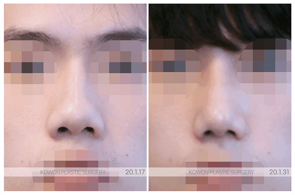 남자 코성형 상담 전 기준 정리 — 어떤 수술이 아니라 어떤 기준으로 고를 것인가 관련 이미지 2/7