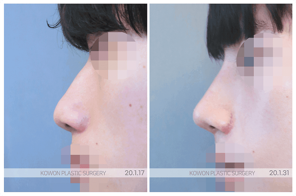 남자 코성형 상담 전 기준 정리 — 어떤 수술이 아니라 어떤 기준으로 고를 것인가 관련 이미지 4/7