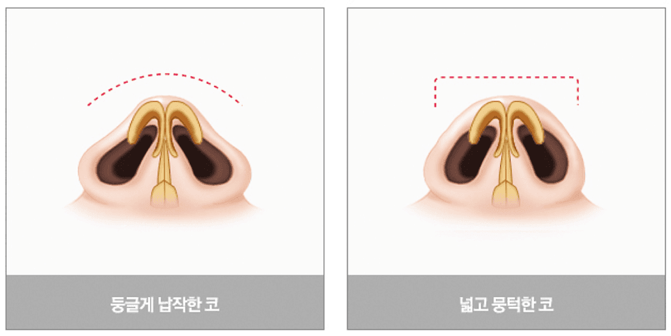 男性の鼻手術費用、団子鼻形態によってなぜ変わりますか — 材料·デザイン·皮膚の厚さ 関連画像 1/6