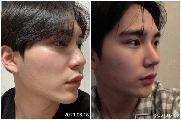 ภาพก่อนและหลังการผ่าตัดจมูกชาย วิธีเลือกทรงจมูก — เกณฑ์ในการพิจารณา ภาพก่อนและหลังการผ่าตัด ภาพที่เกี่ยวข้อง 5/5