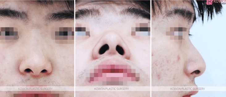 코성형 3년 뒤 비주에 생긴 여드름 같은 트러블 — 단순 피부 염증과 코성형 염증 구분하기 관련 이미지 4/10