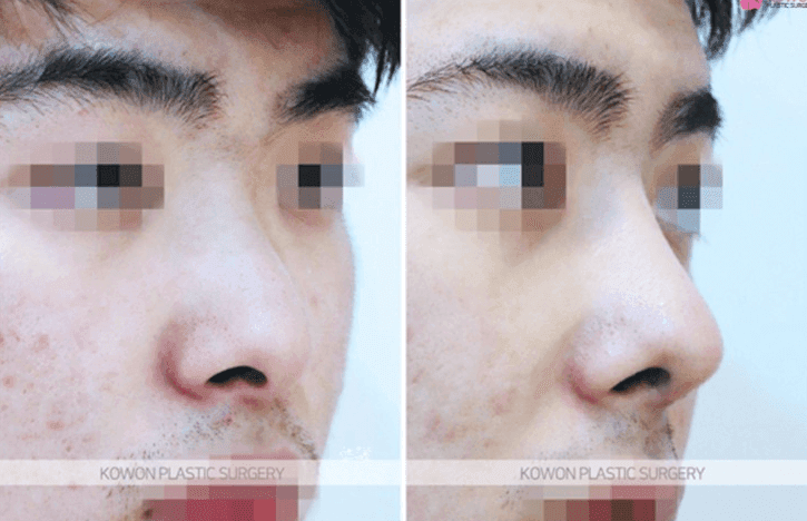 코성형 3년 뒤 비주에 생긴 여드름 같은 트러블 — 단순 피부 염증과 코성형 염증 구분하기 관련 이미지 6/10