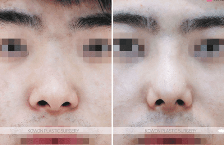 코성형 3년 뒤 비주에 생긴 여드름 같은 트러블 — 단순 피부 염증과 코성형 염증 구분하기 관련 이미지 7/10
