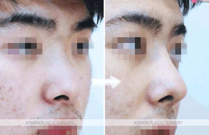 코성형 3년 뒤 비주에 생긴 여드름 같은 트러블 — 단순 피부 염증과 코성형 염증 구분하기 관련 이미지 9/10