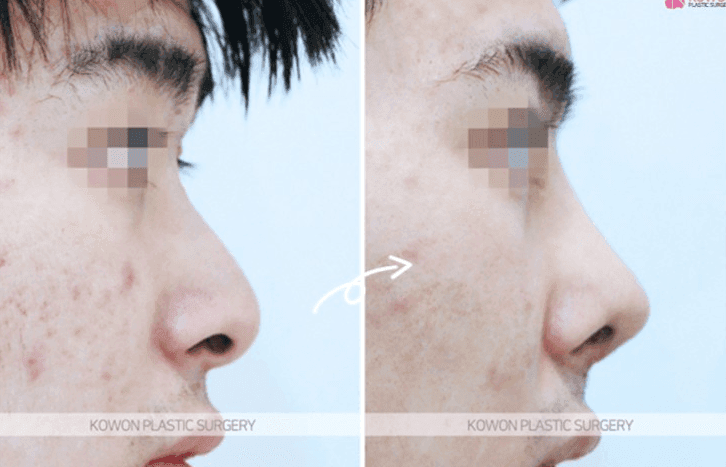 코성형 3년 뒤 비주에 생긴 여드름 같은 트러블 — 단순 피부 염증과 코성형 염증 구분하기 관련 이미지 10/10