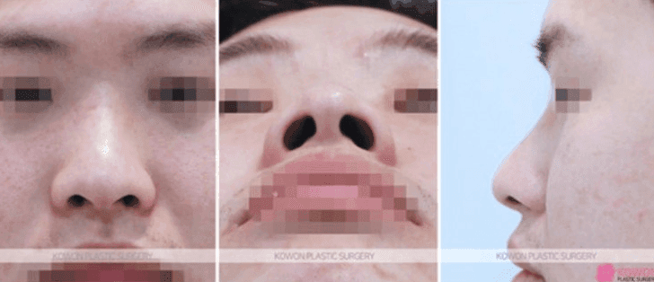 남자 코 성형, 무엇을 보고 결정하나요? — 지식iN 질문과 복코 교정 사례로 본 기준 관련 이미지 4/10