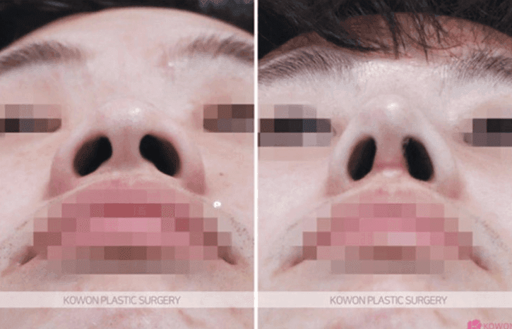 남자 코 성형, 무엇을 보고 결정하나요? — 지식iN 질문과 복코 교정 사례로 본 기준 관련 이미지 6/10
