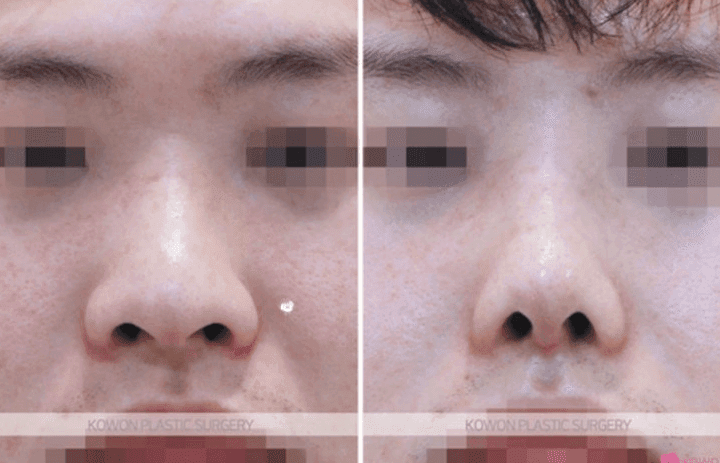 남자 코 성형, 무엇을 보고 결정하나요? — 지식iN 질문과 복코 교정 사례로 본 기준 관련 이미지 9/10
