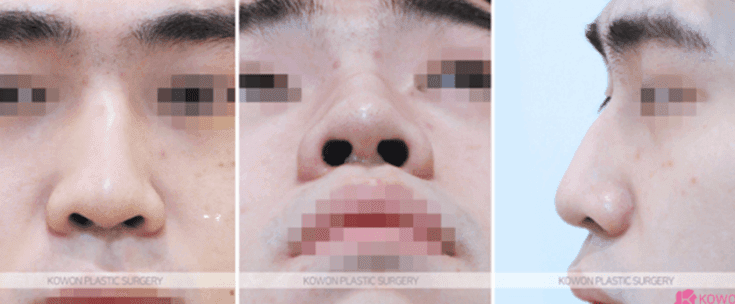 남자 코성형으로 달라지는 T존 입체감 — 미간·콧대는 어떤 방법으로 보완하나요? 관련 이미지 4/11