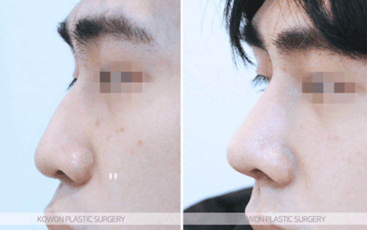 남자 코성형으로 달라지는 T존 입체감 — 미간·콧대는 어떤 방법으로 보완하나요? 관련 이미지 6/11