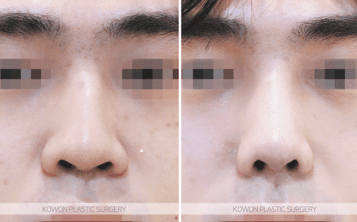 남자 코성형으로 달라지는 T존 입체감 — 미간·콧대는 어떤 방법으로 보완하나요? 관련 이미지 7/11