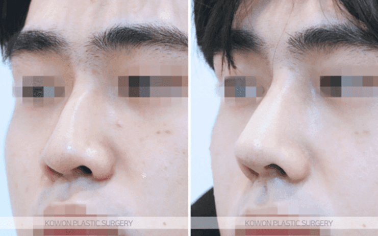 남자 코성형으로 달라지는 T존 입체감 — 미간·콧대는 어떤 방법으로 보완하나요? 관련 이미지 8/11