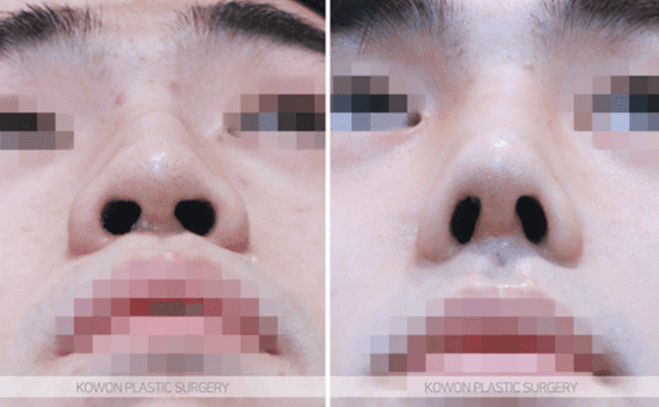 남자 코성형으로 달라지는 T존 입체감 — 미간·콧대는 어떤 방법으로 보완하나요? 관련 이미지 9/11