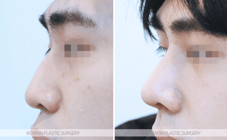 남자 코성형으로 달라지는 T존 입체감 — 미간·콧대는 어떤 방법으로 보완하나요? 관련 이미지 10/11