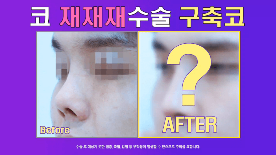 남자 코재수술, 구축으로 들린 코를 자가 조직으로 개선한 사례 관련 이미지 1/8